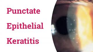 Punctate Epithelial Keratitis PEK [upl. by Afas598]