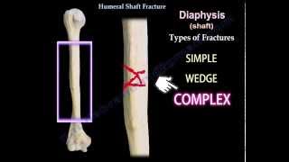 Humeral Shaft Fracture  Everything You Need To Know  Dr Nabil Ebraheim [upl. by Allimrac740]