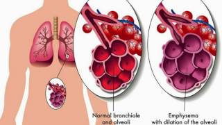 Chronic Bronchitis  Causes Symptoms Treatments amp More… [upl. by Aicile]