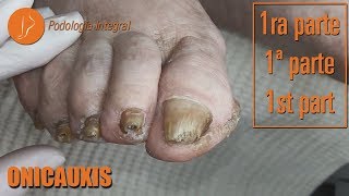 Onicauxis onychomycosis amp callosities Part 1 podologiaintegral [upl. by Eivets]