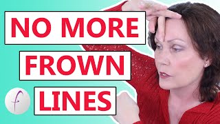 How to Remove Frown Lines Naturally [upl. by Buehrer775]