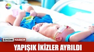 Yapışık ikizler ayrıldı [upl. by Corb]