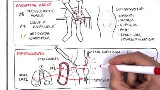 Septic Arthritis  Overview causes pathophysiology treatment [upl. by Salocin]