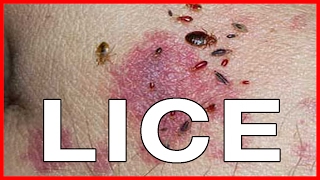 Pubic Lice or Crabs Info about Transmission Treatments Cure and Pictures [upl. by Aneeg966]