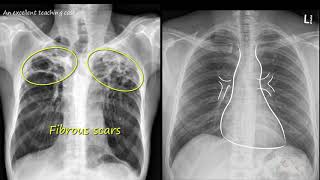 Chest x ray  Tuberculosis healed TB Inactive TB [upl. by Meneau301]