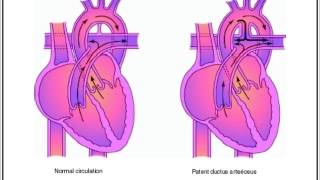 Patent ductus arteriosus machinery murmur [upl. by Dallis]