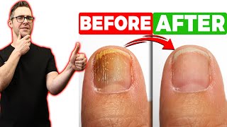 Best Toe Nail Fungus Treatments Onychomycosis Remedies [upl. by Teddman]