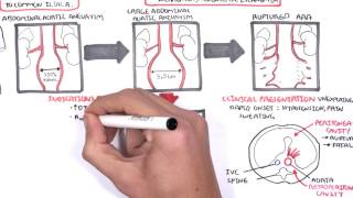 Abdominal Aortic Aneurysm  Summary [upl. by Kalagher]