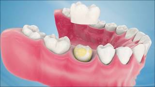 Dental Crown Procedure [upl. by Hedva801]