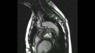 Patent ductus arteriosus on echocardiography [upl. by Aikit]