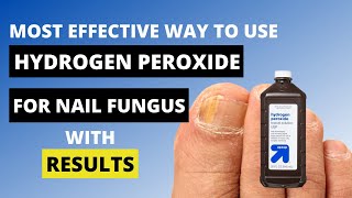 3 Ways to Use Hydrogen Peroxide for Nail Fungus  Toe Fungus Journey [upl. by Ahsyas]