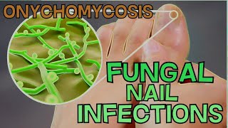 ONYCHOMYCOSIS  FUNGAL NAIL INFECTION  DEFINITION SYMPTOMS TREATMENT  EXPLAINED in 5 Minutes [upl. by Kelbee]