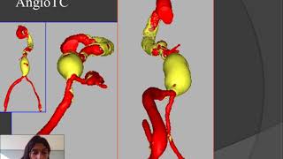 Minimally Invasive Complex Abdominal Aortic Aneurysm Surgery [upl. by Hackett]