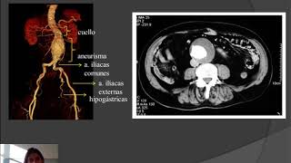 Understanding Abdominal Aortic Aneurysms  Access Health [upl. by Frierson618]