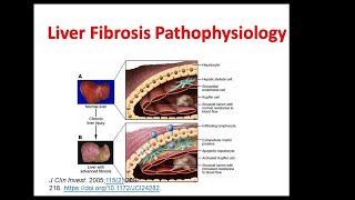 Liver fibrosis Pathophysiology and etiology Liver Cirrhosis  Hepatic Stellate Cells Liver cancer [upl. by Kimber]