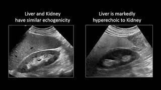 GI Imaging  Hepatic Steatosis and Cirrhosis [upl. by Petras]