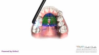 Pendex  Orthodontic Appliance [upl. by Nymassej]