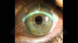 Full Thickness Corneal Transplantation Penetrating Keratoplasty PKP [upl. by Ariom469]