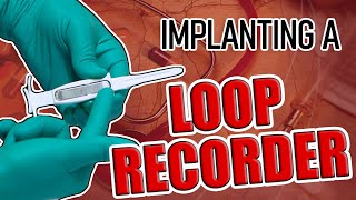 Loop Recorder Implant Procedure [upl. by Eeltrebor]