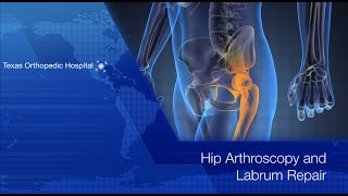 Hip Arthroscopy and Labrum Repair  Dr Gombera [upl. by Ushijima]