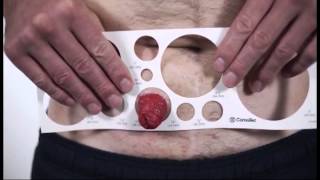 Measuring – How to size your stoma [upl. by Rabiah]