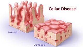 Celiac Disease [upl. by Airahcaz]