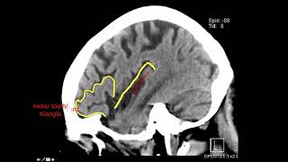 Introduction to Brain Surface Anatomy [upl. by Ralli]