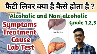 fatty liver in hindi  Fatty Liver diseases symptoms  Alcoholic vs Nonalcoholic fatty liver [upl. by Jeff]