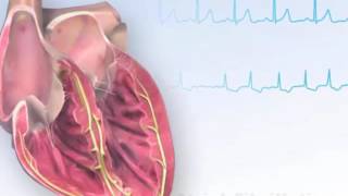 American Heart Association AHA Atrial Fibrillation Animation [upl. by Bartie]