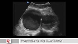 Aneurisma Aorta Abdominal Doppler [upl. by Juster912]