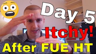 Day 5 after FUE Hair Transplant [upl. by Marc]