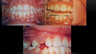 Frankel Activator 2 Orthodontist [upl. by Enyahs]