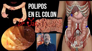 Pólipos en el colon [upl. by Isteb]