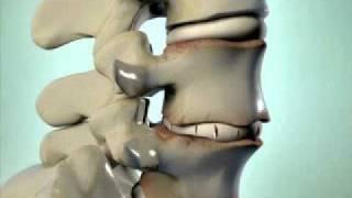 Degenerative Disc Disease  DePuy Videos [upl. by Sydel]