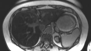 Hepatic Steatosis [upl. by Jaquelyn533]