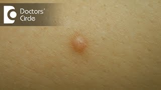 Diagnosis of skin colored lump with brown spot  Dr Nanda Rajaneesh [upl. by Feigin]