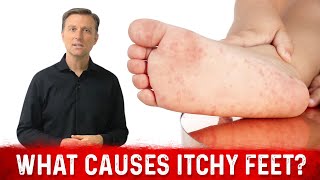 What Causes Itchy Feet and How to Stop It – Dr Berg [upl. by Sagerman]