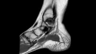 Ankle MRI anatomy [upl. by Mashe]