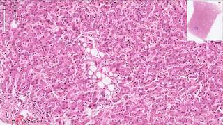 Hepatic Steatosis  Histopathology  Normal Liver Histology [upl. by Pul]