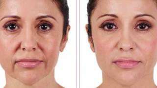 Botox vs Juvederm [upl. by Horton]