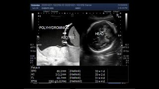 Ultrasound Video showing a Pregnancy of 32 weeks with Polyhydromnios ascites and sluggish fetus [upl. by Mathe]