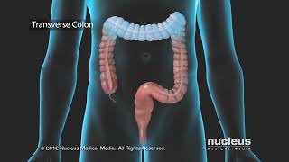 Colon Problems Diverticular Disease [upl. by Rebhun]