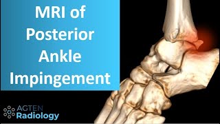 Posterior ankle impingement on MRI [upl. by Adivad]