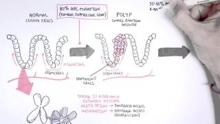 Colon Cancer Carcinogensis [upl. by Walston]