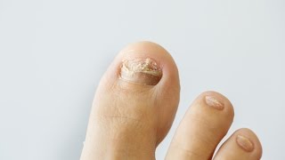 How to prevent and treat nail fungus [upl. by Hanala]