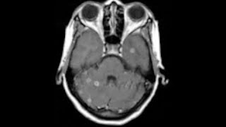 NEURORADIOLOGY CNS Infections  I  DEEPAK PATKAR  Tuberculomas vs Cysticercosis [upl. by Meit]