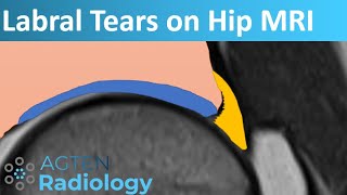 Labral Tears on Hip MRI [upl. by Yojal]