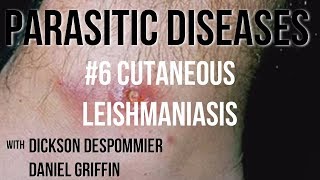 Parasitic Diseases Lectures 6 Cutaneous Leishmaniasis [upl. by Llahsram799]