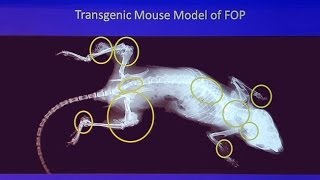 Genetic Mysteries FOP  When Bodies Turn to Bone [upl. by Eenhat]