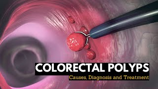 Colorectal Polyps Causes Signs and Symptoms Diagnosis and Treatment [upl. by Gaillard]